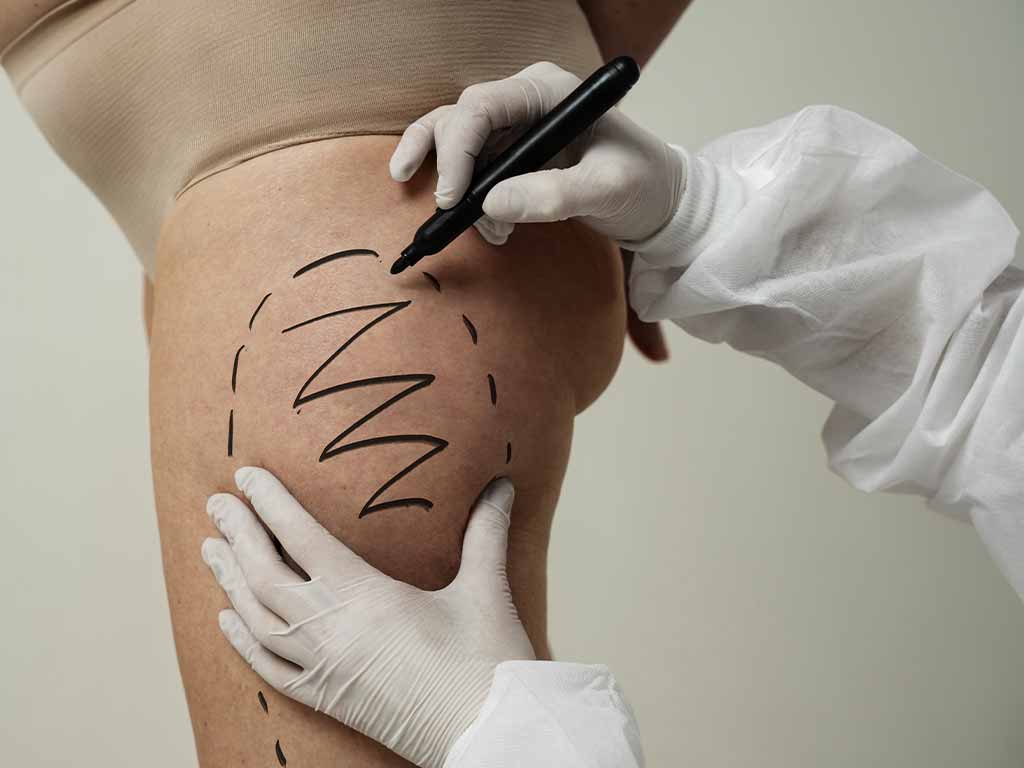 lipoaspiração para lipedema negada pelo plano de saúde